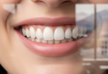 Close-up of a bright, healthy, and natural-looking smile with perfectly contoured teeth, symbolizing successful composite bonding. The background is softly blurred, hinting at a modern, high-end dental clinic setting in Switzerland. No visible text or branding.