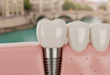 A detailed, photorealistic close-up of a perfectly crafted dental implant with a white ceramic crown, set against a softly blurred background showing the historic buildings and river of Bern, Switzerland.